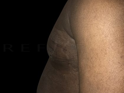 Gynaecomastia Before & After Patient #6733