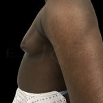Gynaecomastia Before & After Patient #6733