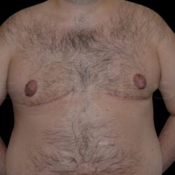Gynaecomastia Before & After Patient #6732