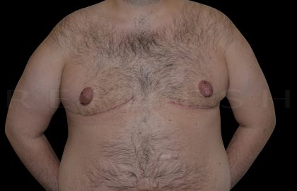 Gynaecomastia Before & After Patient #6732