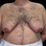 Gynaecomastia Before & After Patient #6732