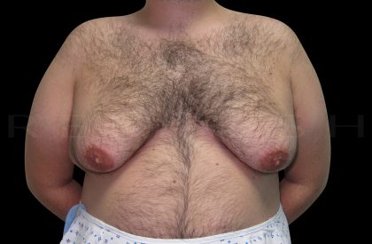 Gynaecomastia Before & After Patient #6732