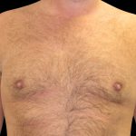 Gynaecomastia Before & After Patient #6731
