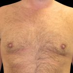 Gynaecomastia Before & After Patient #6731