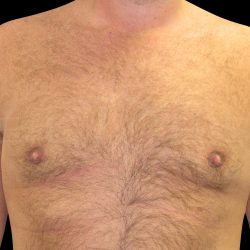 Gynaecomastia Before & After Patient #6731