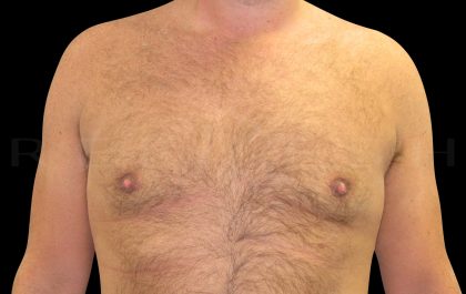 Gynaecomastia Before & After Patient #6731