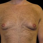 Gynaecomastia Before & After Patient #6731