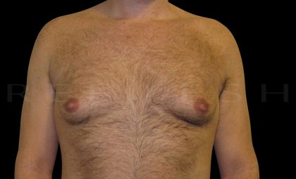 Gynaecomastia Before & After Patient #6731