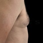 Gynaecomastia Before & After Patient #6730