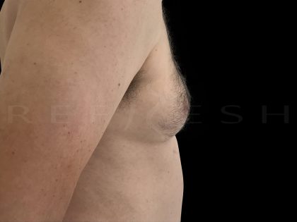 Gynaecomastia Before & After Patient #6730