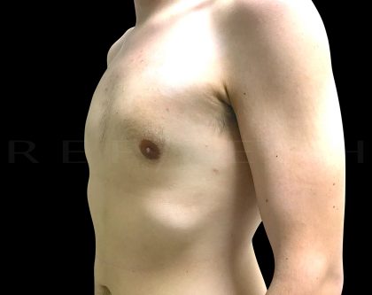 Gynaecomastia Before & After Patient #6729