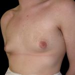 Gynaecomastia Before & After Patient #6729