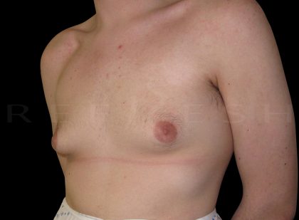 Gynaecomastia Before & After Patient #6729
