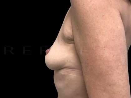 Inverted Nipple Correction Before & After Patient #6653