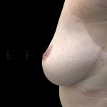 Inverted Nipple Correction Before & After Patient #6653