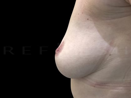 Inverted Nipple Correction Before & After Patient #6653