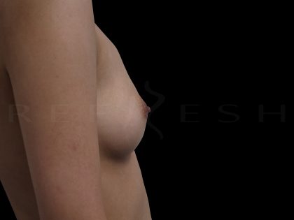 Inverted Nipple Correction Before & After Patient #6652