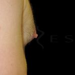 Nipple Reduction Before & After Patient #6650