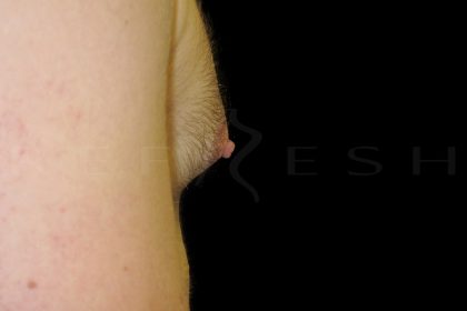 Nipple Reduction Before & After Patient #6650