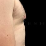 Nipple Reduction Before & After Patient #6650