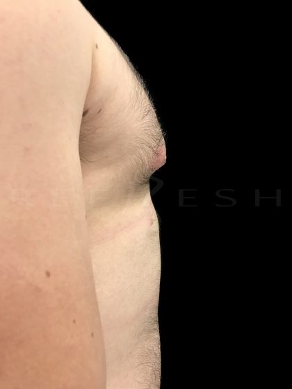 Nipple Reduction Before & After Patient #6650