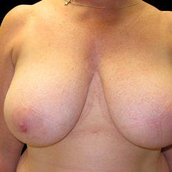 Onco plastic Surgery Before & After Patient #6663