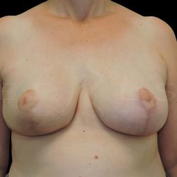 Onco plastic Surgery Before & After Patient #6662