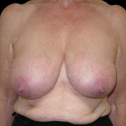 Onco plastic Surgery Before & After Patient #6661
