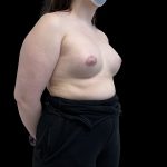 Tuberous Breasts Correction Before & After Patient #6672