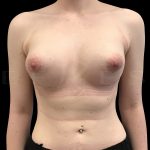 Tuberous Breasts Correction Before & After Patient #6671