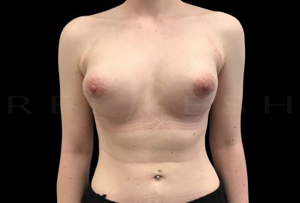 Tuberous Breasts Correction Before & After Patient #6671