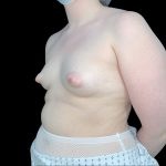 Tuberous Breasts Correction Before & After Patient #6670
