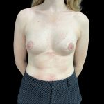 Tuberous Breasts Correction Before & After Patient #6669