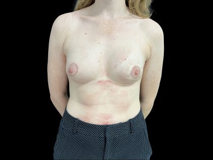 Tuberous Breasts Correction Before & After Patient #6669