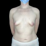 Tuberous Breasts Correction Before & After Patient #6669