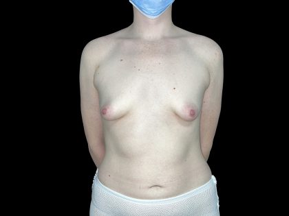 Tuberous Breasts Correction Before & After Patient #6669