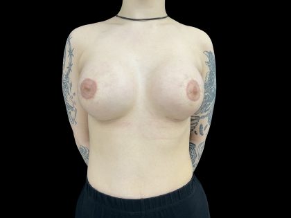 Tuberous Breasts Correction Before & After Patient #6668