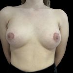 Tuberous Breasts Correction Before & After Patient #6667