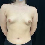 Tuberous Breasts Correction Before & After Patient #6667