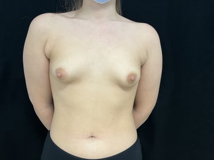 Tuberous Breasts Correction Before & After Patient #6667