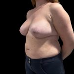 Tuberous Breasts Correction Before & After Patient #6666