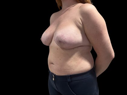 Tuberous Breasts Correction Before & After Patient #6666