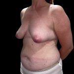 Tuberous Breasts Correction Before & After Patient #6666