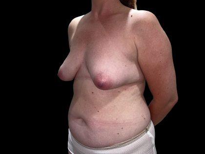 Tuberous Breasts Correction Before & After Patient #6666