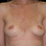 Breast Implant Removal with Breast Lift Before & After Patient #6983