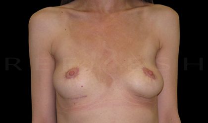 Breast Implant Removal with Breast Lift Before & After Patient #6983