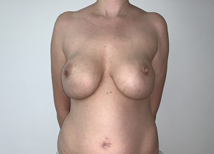 Breast Implant Removal with Breast Lift Before & After Patient #7012