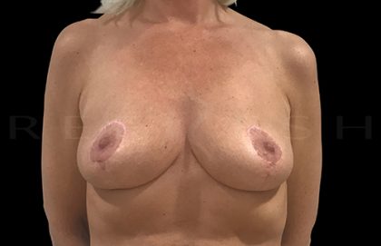 Before & After Patient #6990