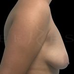 Breast Lift with Implants Before & After Patient #6916