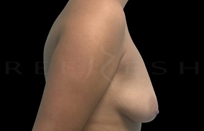 Breast Lift with Implants Before & After Patient #6916